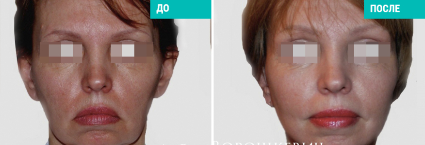 Фейслифтинг