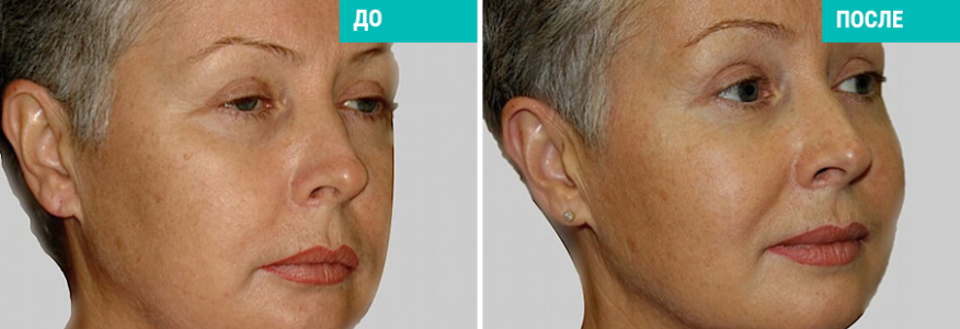 Эндоскопический лифтинг лица