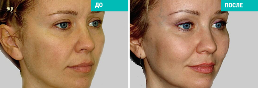 Эндоскопический лифтинг лица