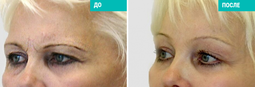 Эндоскопический лобно-височный лифтинг