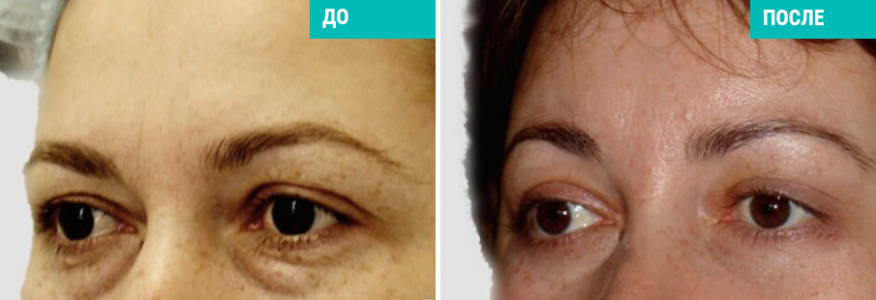 Эндоскопический лобно-височный лифтинг