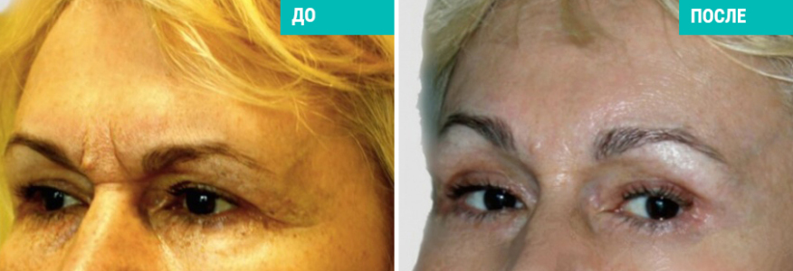 Эндоскопический лобно-височный лифтинг