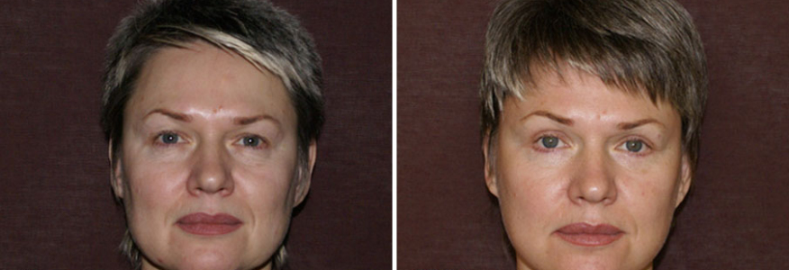 Пластика лица