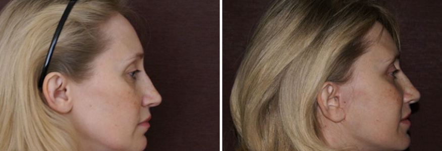 Пластика лица