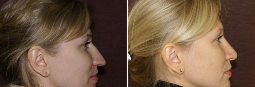 Ринопластика