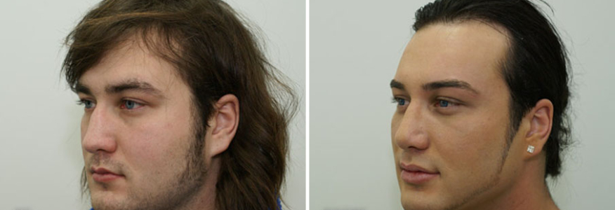 Ринопластика