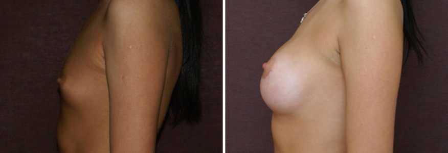 Увеличение груди