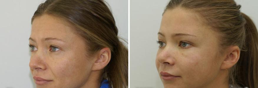 Эндоскопическая подтяжка лица