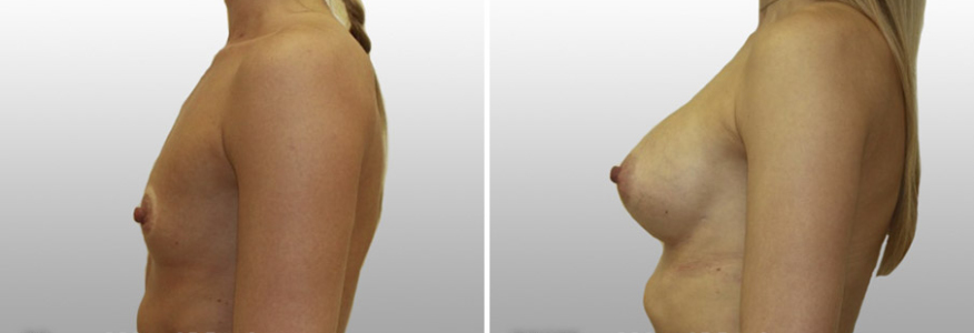 Увеличение груди