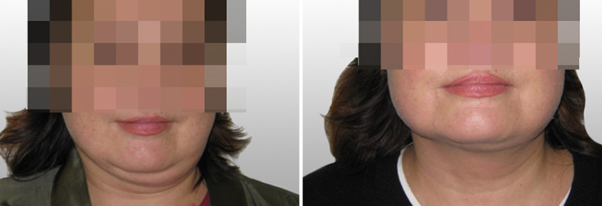 Липосакция