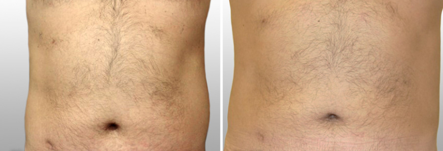 Липосакция