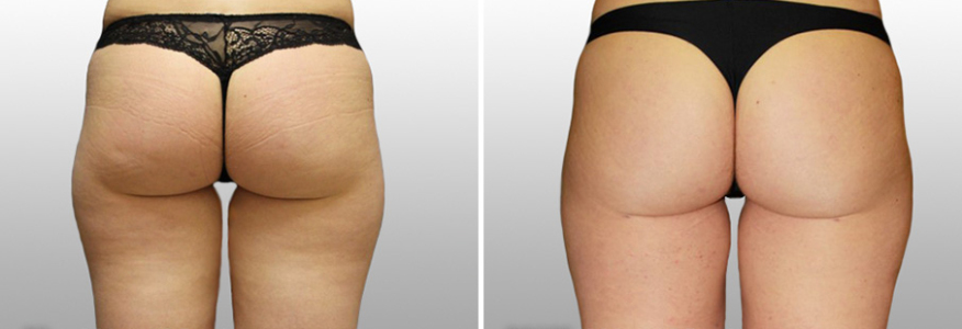 Липосакция