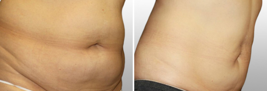 Липосакция