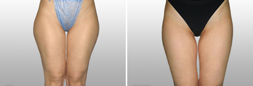 Липосакция