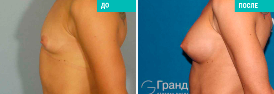 Увеличение груди