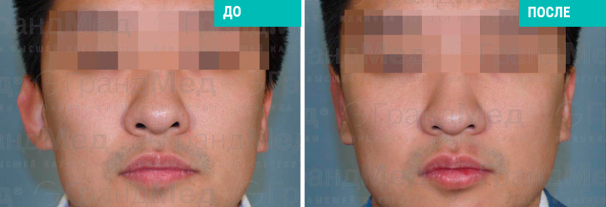 Отопластика