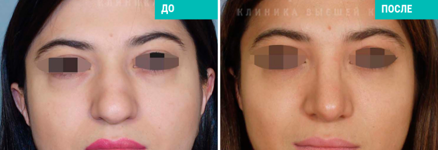 Ринопластика