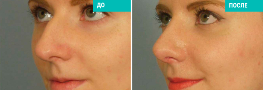 Ринопластика