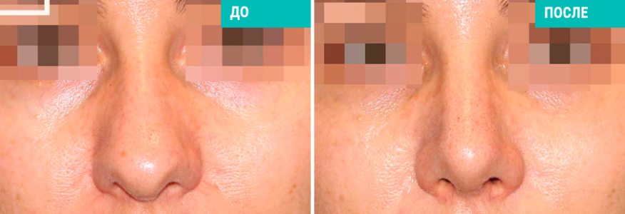 Ринопластика