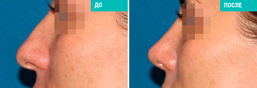 Ринопластика