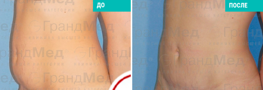 Липосакция