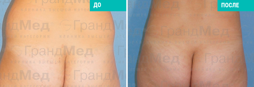 Липосакция