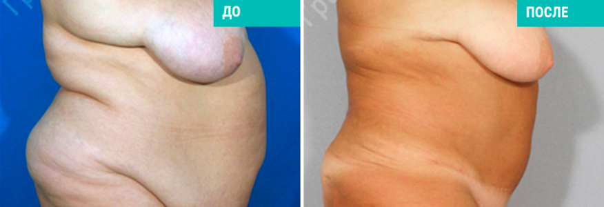 Липосакция