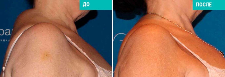 Липосакция