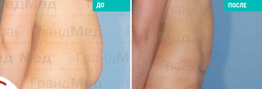 Липосакция