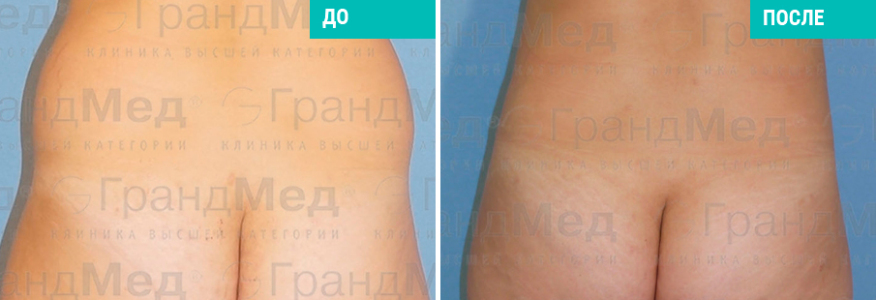 Липосакция