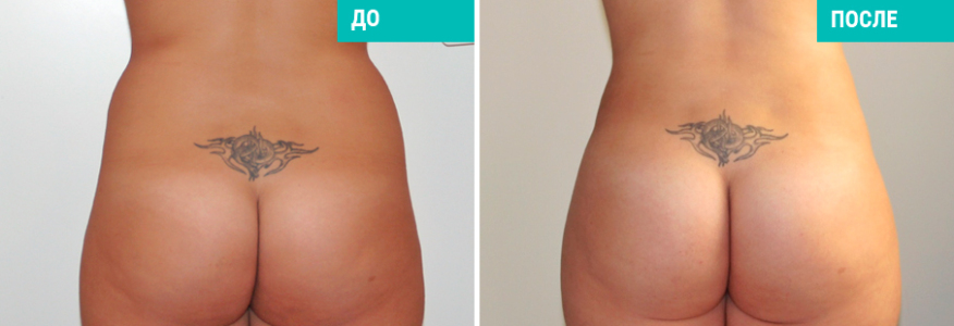 Липосакция