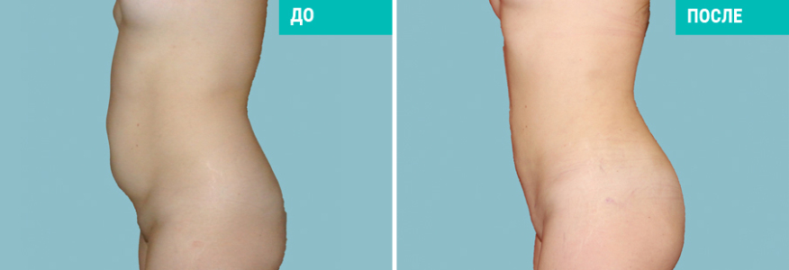 Липосакция