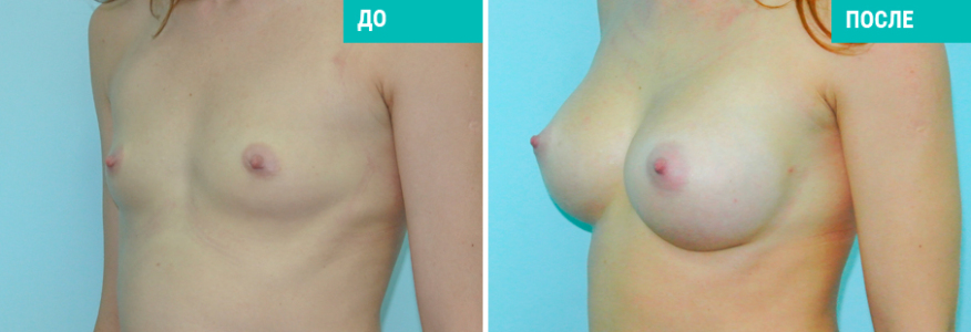 Увеличение груди