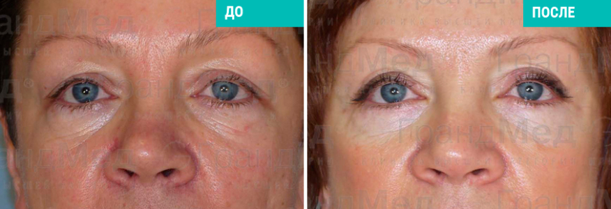 Блефаропластика