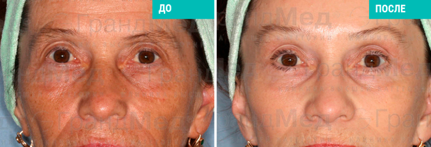 Фейслифтинг