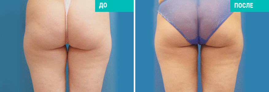 Липосакция