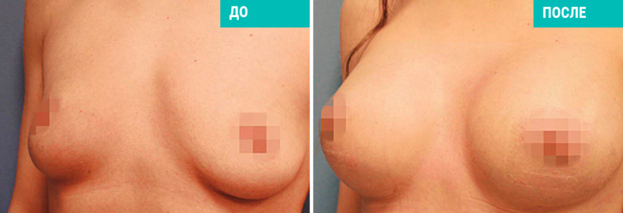 Увеличение груди