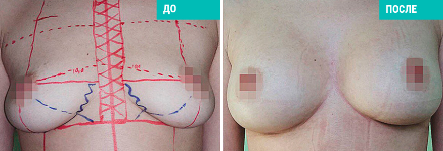Увеличение груди