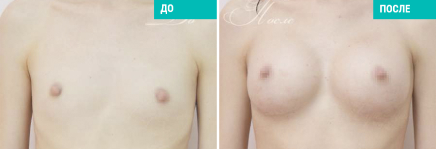 Увеличение груди, анатомы 290, Натрелле, 2 мес