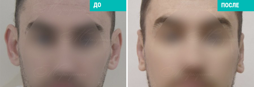 Отопластика