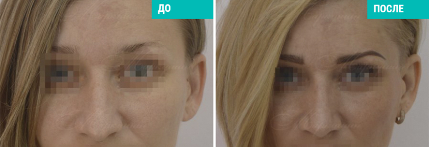 Риносептопластика