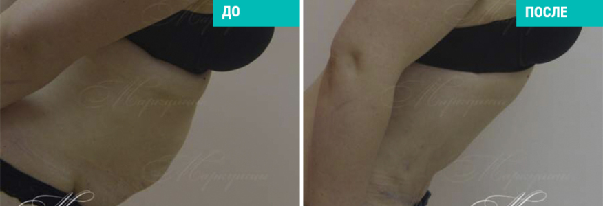 Абдоминопластика + липосакция