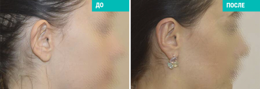 Отопластика