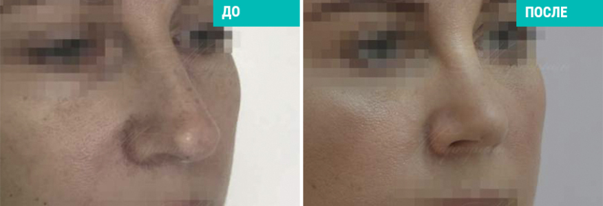 Риносептопластика