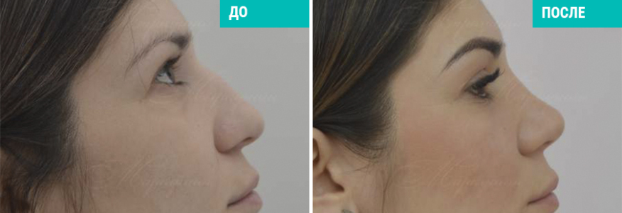 Риносептопластика