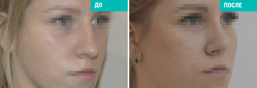 Риносептопластика