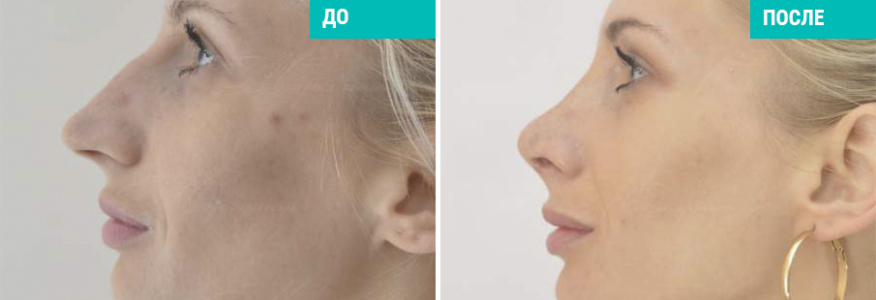 Риносептопластика