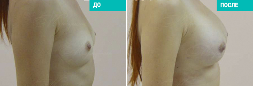 Увеличение груди