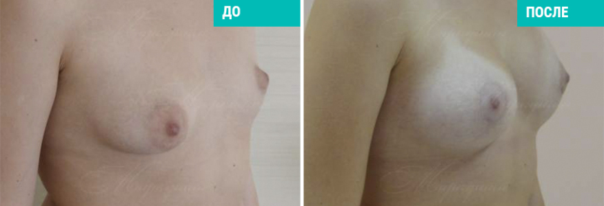 Увеличение груди