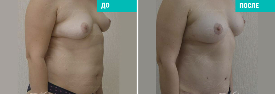 Увеличение груди + абдоминопластика + липосакция живота